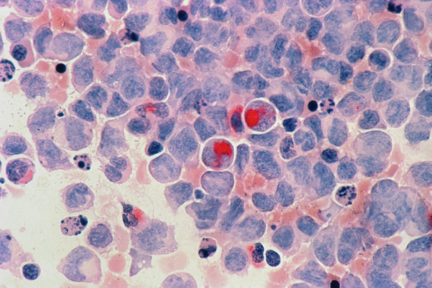 Blood cancer trial delivered at the NIHR King's Clinical Research Facility shows novel results