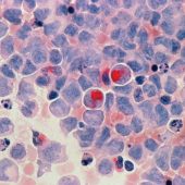 Leukemia cells