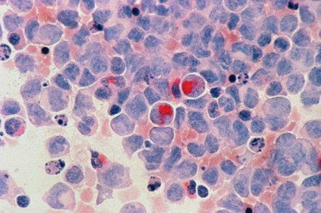 Leukemia cells